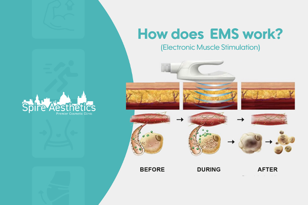 EMS treatment for post pregnancy weight loss treatment Isleworth