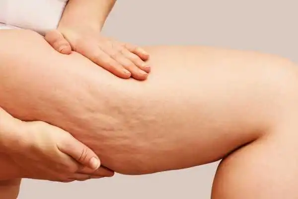 Image of woman showing leg with cellulite Isleworth