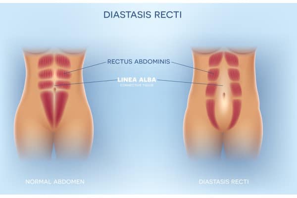How Does Non-Surgical Treatment Help With Loose Skin, Weak Abdominal Muscles and Post-Pregnancy Changes Isleworth?