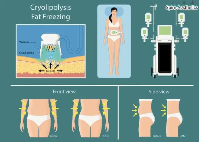 Fat freezing treatment Isleworth benefits for competitions to remove stubborn fat deposits.