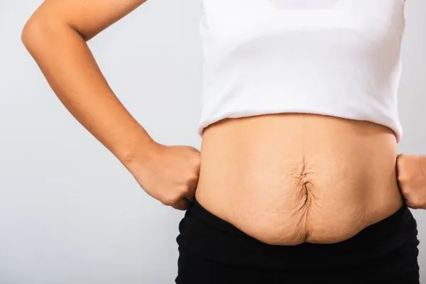 Image of a woman's stomach after weight loss with sagging skin following a gastric band Isleworth