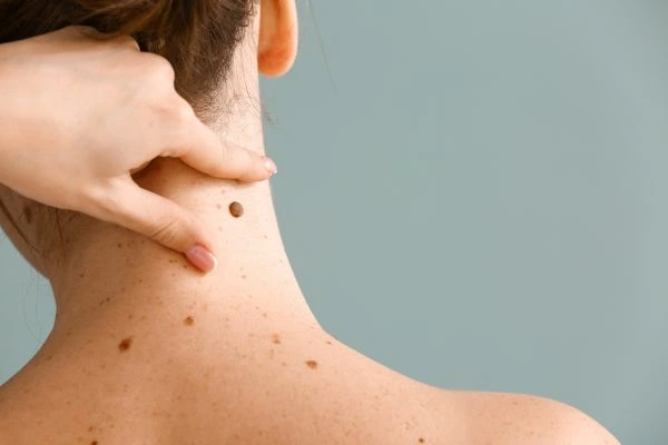 Prices and promotions for blemish removal Isleworth contact our team today!