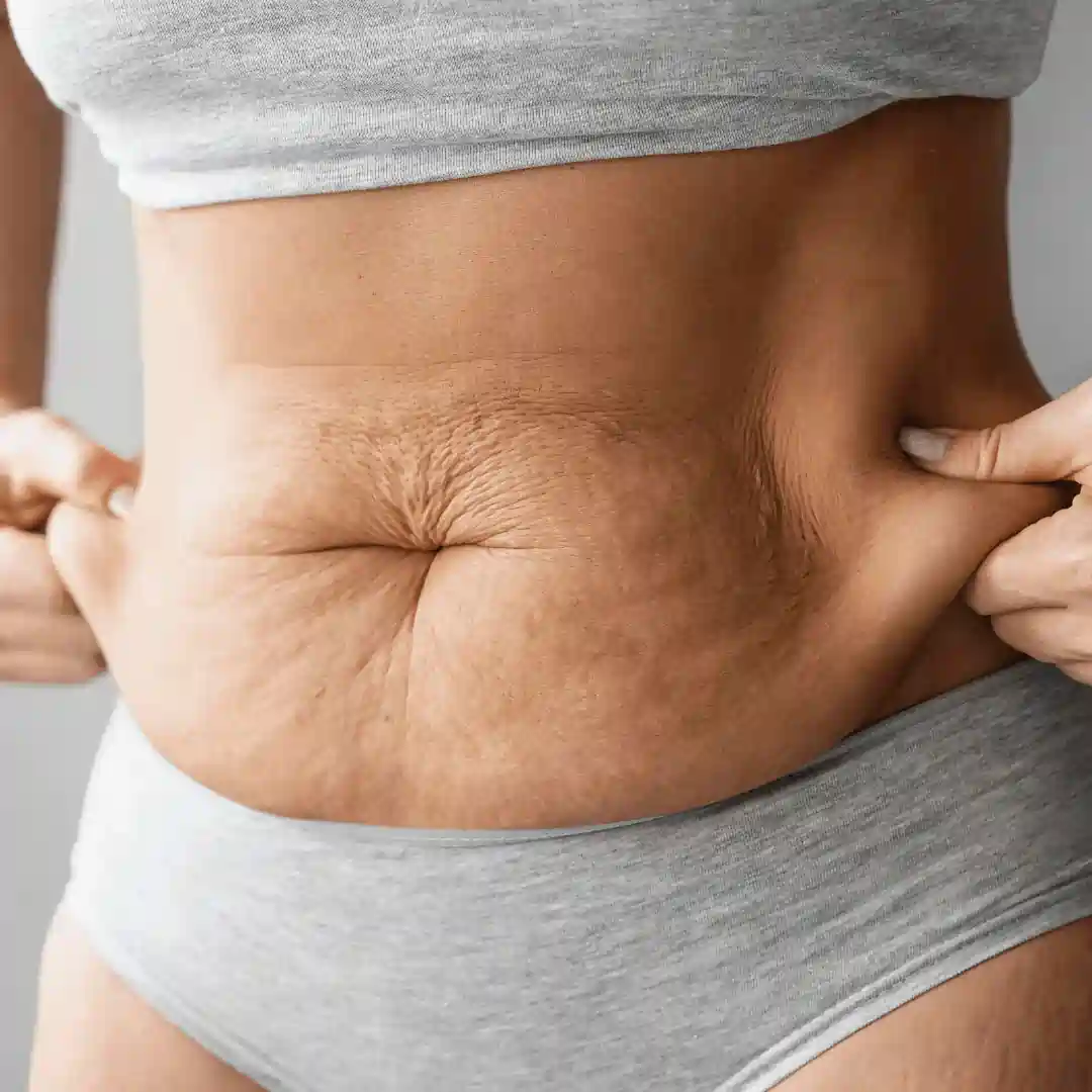 Is It Normal to Have Loose Skin After Pregnancy Isleworth?