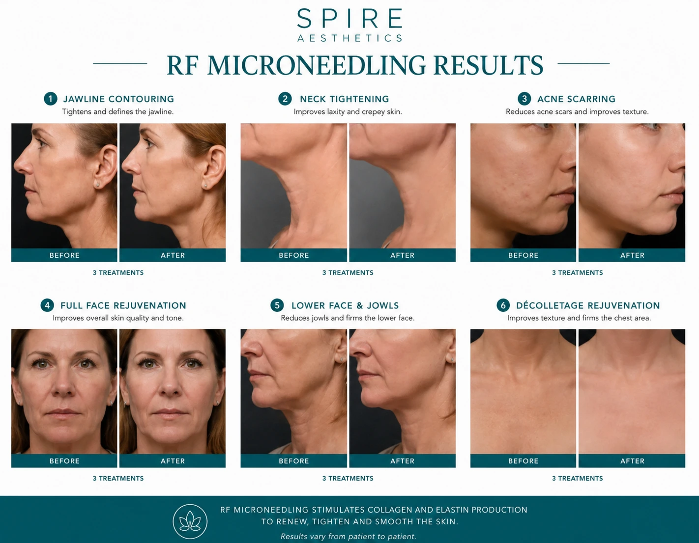 RF Microneedling Skin tightening Isleworth results