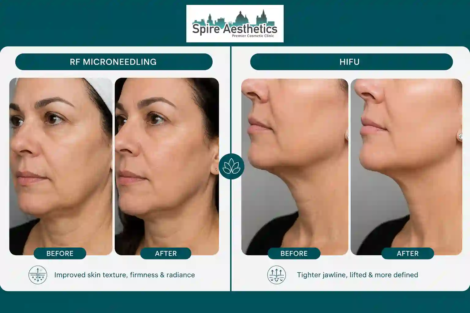 Can RF Microneedling and HIFU Be Combined Isleworth?
