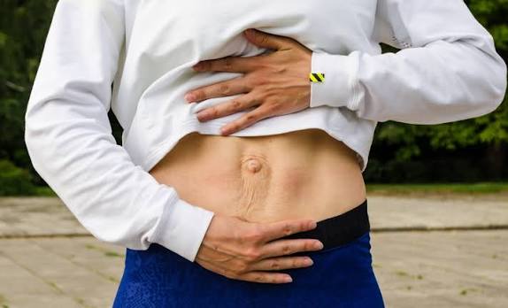 When Could Diastasis Recti Be the Missing Piece of the Puzzle Isleworth?