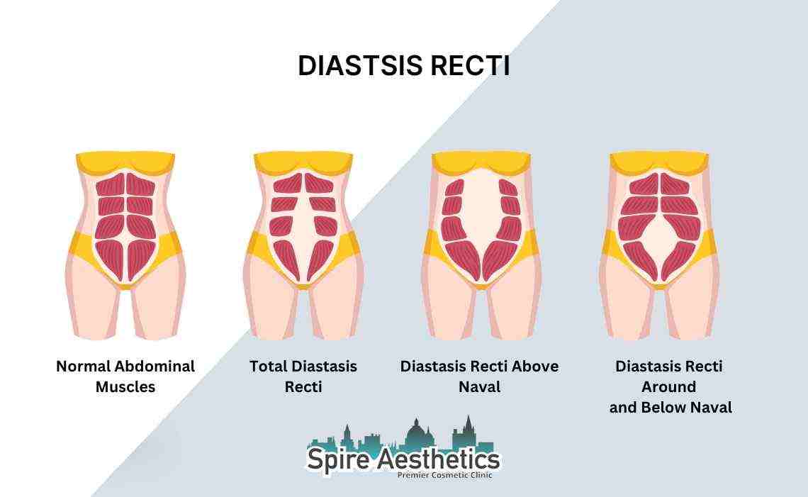 Is Non-Surgical Diastasis Recti Treatment Right for You? Common Concerns Answered Isleworth